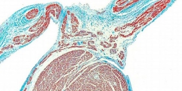 Machine Learning Can Make Cardiology Diagnoses Better than Doctors Can