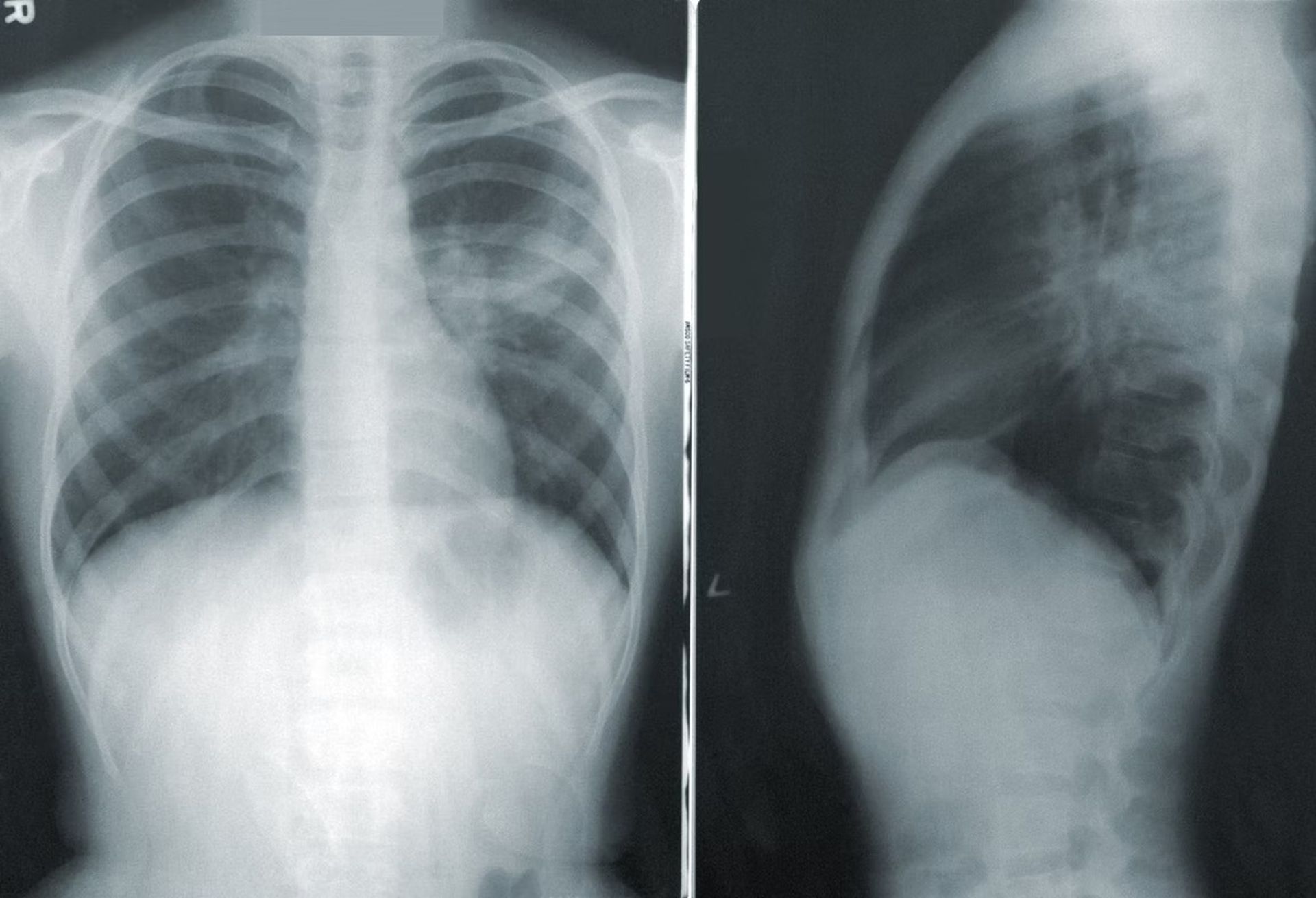 AI can tell people's race from X-rays and CT scans with 90% accuracy, the latest study shows.