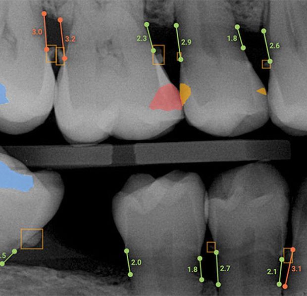 Overjet Dental AI Program Aims To Remove Doubts In The Diagnosis Process