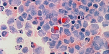 AstraZeneca bets B on Jacobio’s pan-KRAS cancer drug